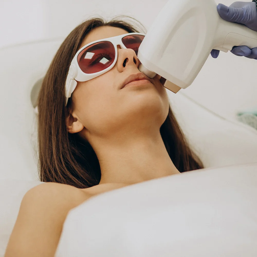 Upper Lip IPL
