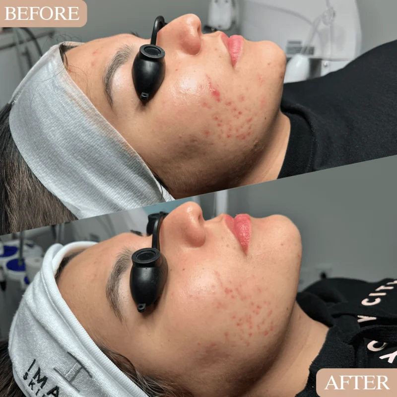 Bi-Weekly Acne facial Treatments (Follow Up)