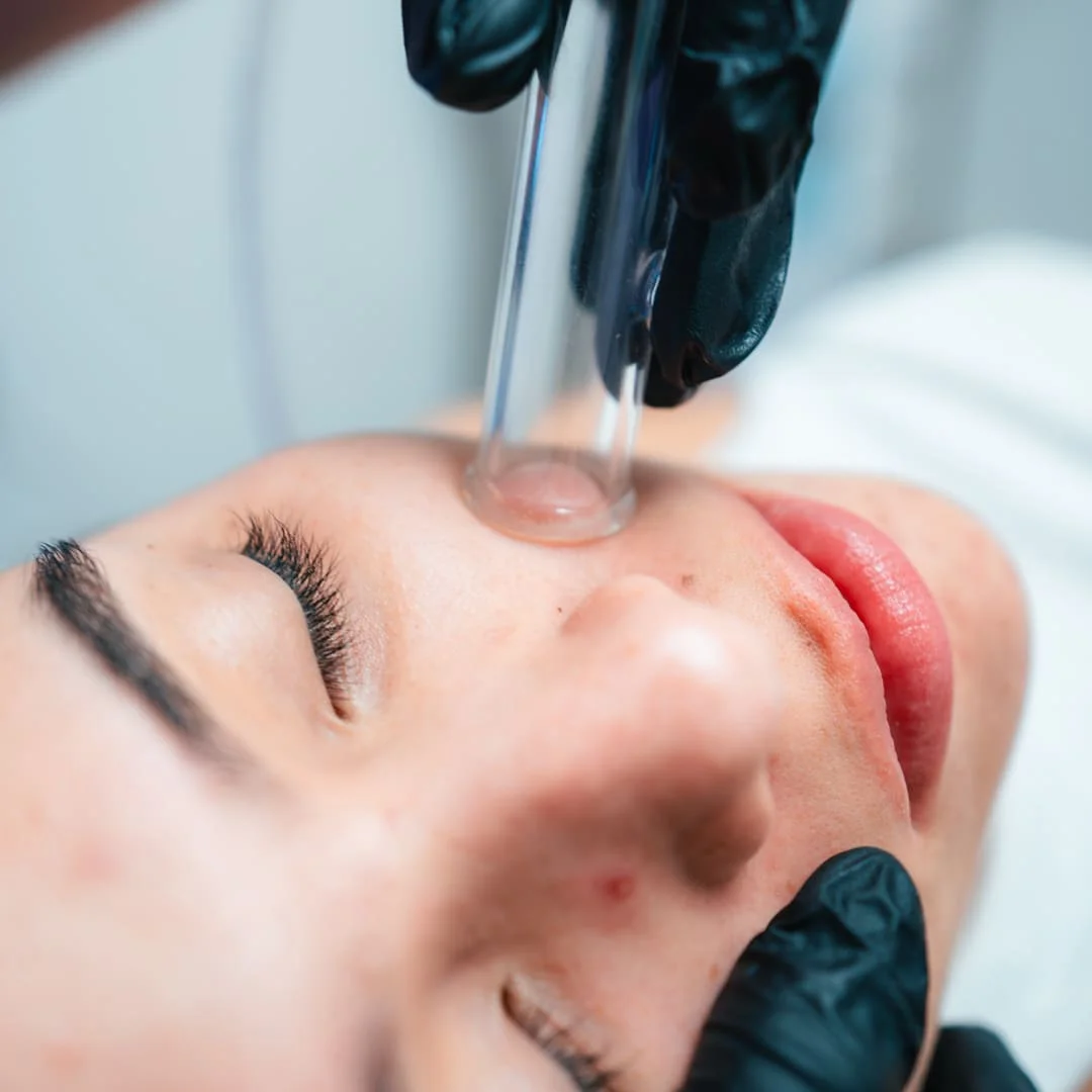 Hydrafacial Barbie Luxe with Microneedling - Image 2