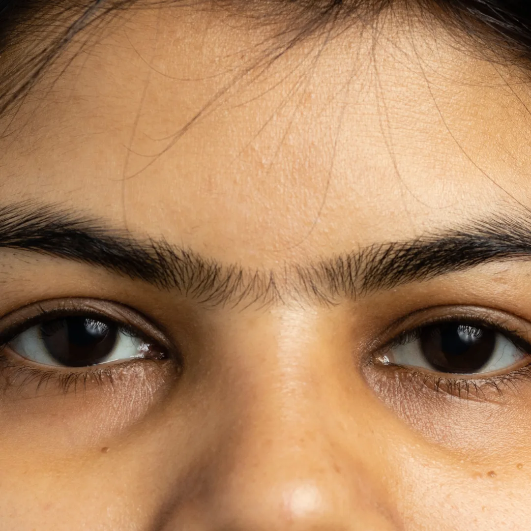 Unibrow/ Entre cejos LHR